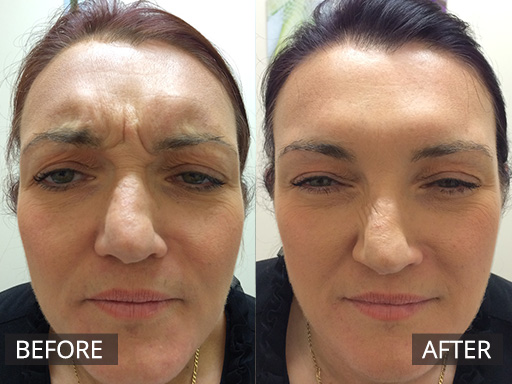 A strong frown nicely softened with anti-wrinkle injections. This patient required 30 units of type b anti-wrinkle injections - 10