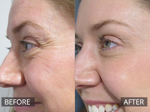 Crows feet lines (“Orbicularis Oculi area”) softened with anti-wrinkle injections (After = 2 weeks post) - 5