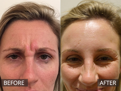 This young woman wanted a softer frown. She was finding people would think she looked angry. A quick treatment and 2 weeks later…no frown with anti-wrinkle injections. - 12
