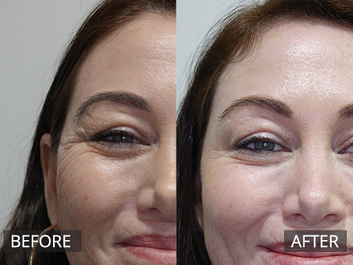 A nice natural result post anti-wrinkle injections to Crows feet line area (2 week mark post injections) - 6