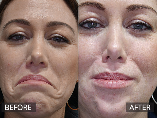 Lower face rejuvenation ("depressor mouth muscles or known as Depressor Angularis oris"). This is a good preventative treatment for the lower face and peri-oral areas to reduce the sad appearance of our mouths as we age. - 2
