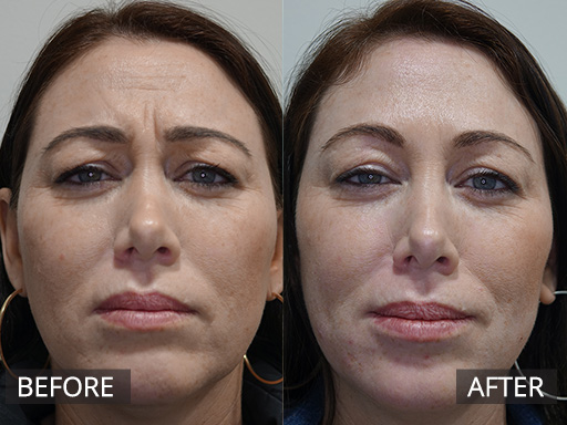 Frown ("Glabella area") treated with anti-wrinkle injection. The result seen is 2 weeks post treatment - 1