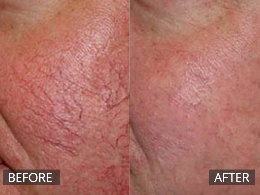Cheek spider veins treated with with the Cutera Nd:YAG (1064nm) laser (Before and post 3 treatments) - 4