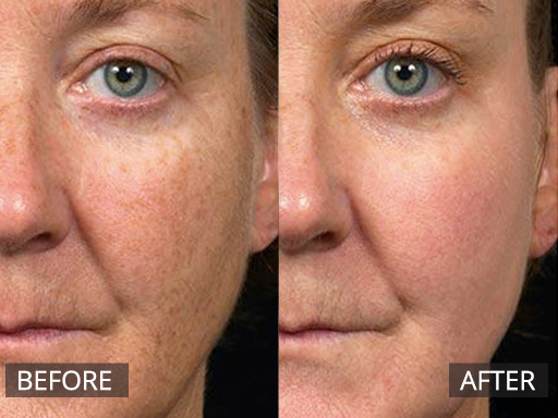 Sun damage (pigmentation) reduced with one visit with Fraxel Dual (1927nm) laser. This is 2 weeks later. - 3