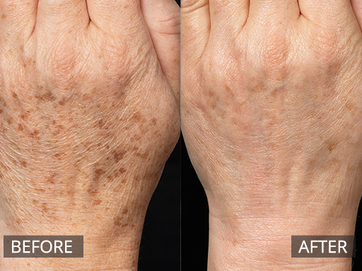 Sun damage and freckles on back of the hand. This was treated with two treatments with the Fraxel Dual (1927nm), 4 weeks apart. - 1