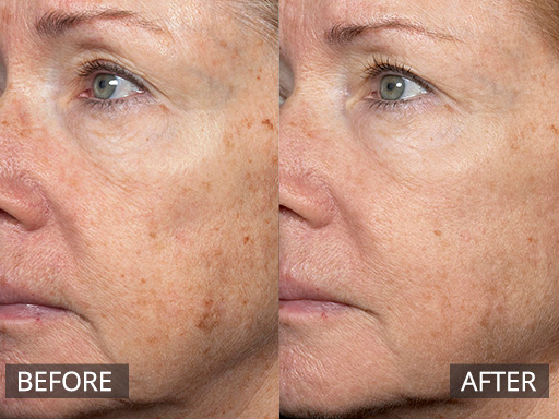 Pigmentation developed over years of sun exposure can be reduced with multiple Fraxel Dual (1927nm) Laser treatments. These can be spaced 4 weeks or more apart. This example shows what one treatment can achieve. - 3