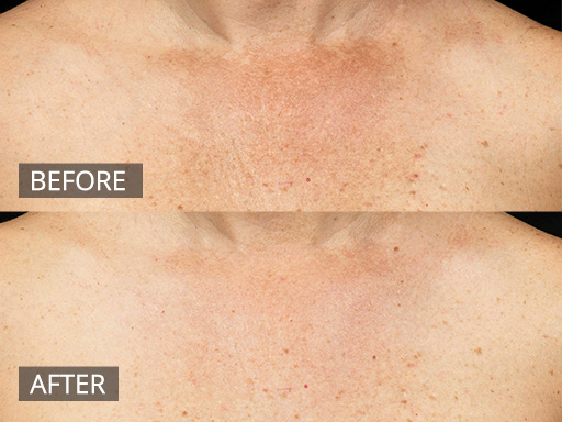 Rejuvenation of sun damage and ageing of the Décolletage area with Fraxel Dual (1927nm) laser. - 4
