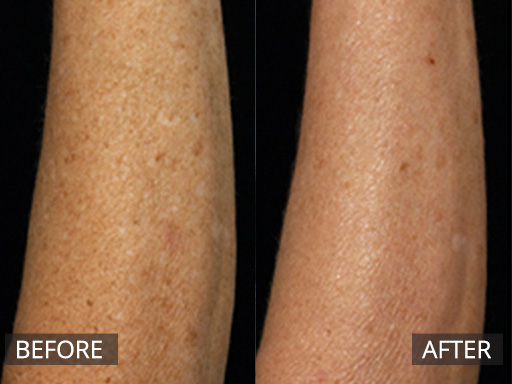 Sun damage improvement with Fraxel Dual (1927nm) laser treatments. - 5