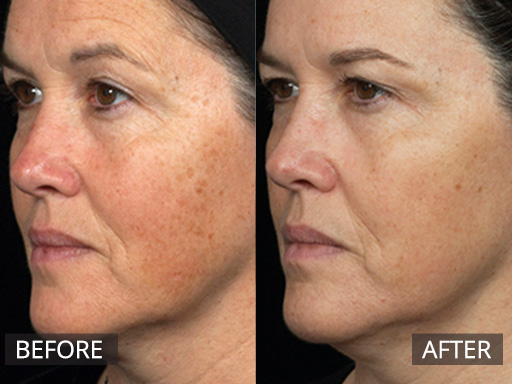 Sun damage on the face was improved with one treatment with the Fraxel Dual (1927nm) Laser. - 2