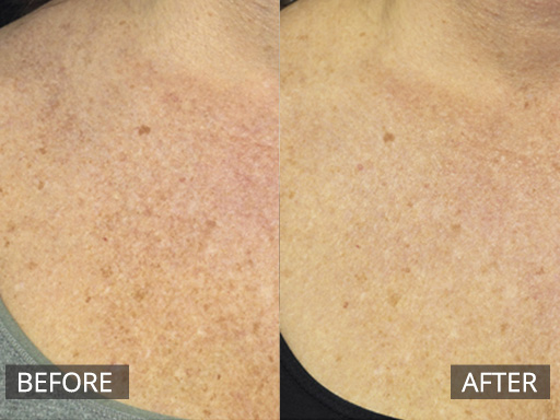 Sundamage to the décolletage can be improved with a few sessions of Fraxel Dual (1927nm) laser. - 7