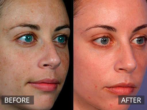 Pigmentation on the face improved with several sessions of Fraxel Dual (1927nm) laser. - 8