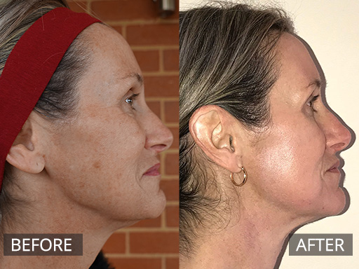 fraxel laser - before and after image 029 - normal size