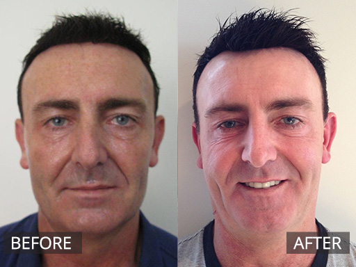 A 47 year old man with extensive sun damage wanted a skin rejuvenation. He underwent 3 Fraxel Dual (1927nm *2 and 1 * 1550nm) laser treatments performed 4 weeks apart. He now has clearer skin. - 3