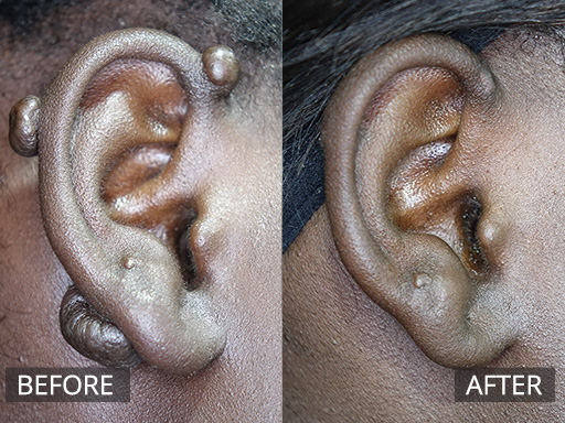 A young woman with multiple keloid scars post ear piercings. The post image is 6 weeks post debulking and one session of anti-inflammatory injections. - 23