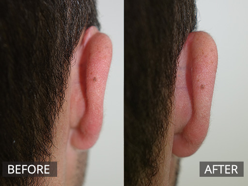 An upper ear keloid scar removed with scar debulking and 2 sessions of anti-inflammatory injections. - 26