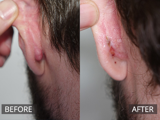 A young man with a posterior earlobe growing scar (keloid scar) debulked and review photo at 2 weeks (revealing nice healing). He will require a course of anti-inflammatory injections to prevent its recurrence. - 24