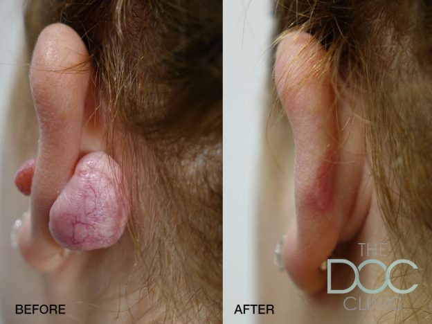 Best Treatment for Keloids & Hypertrophic Scarring | The Doc Clinic - 1