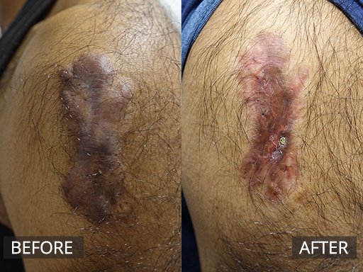 A man with a chronic keloid scar developing post vaccination injection. He required several visits for anti-inflammatory injections to flatten the scar. He will require ongoing silicone gel. - 35