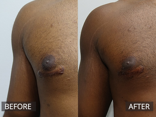 A man in his 20’s developed excessive scarring post-surgery. After one session of anti-inflammatory injections he attained a flattening and improved appearance of his scarring. - 39