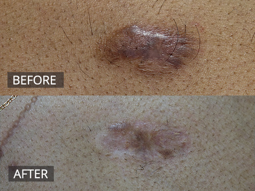 A raised itchy keloid scar on the upper chest post a simple pimple was flattened within 3 months with a few visits for anti-inflammatory injections - 36