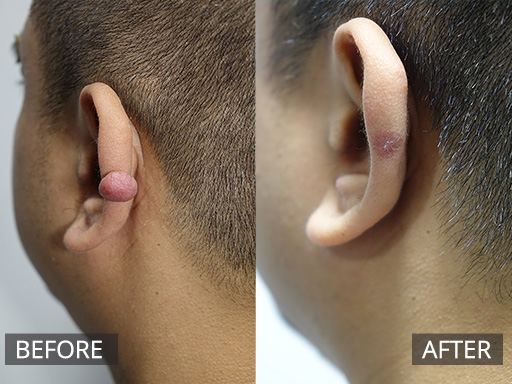 A round keloid scar developed a few months post this man having an ear piercing that was growing and itchy. It was surgically debulked and then injected on a few occasions with anti-inflammatory injections. - 40