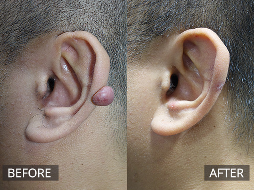 An ear keloid scar. It was surgically debulked and then injected on a few occasions with anti-inflammatory injections. - 41