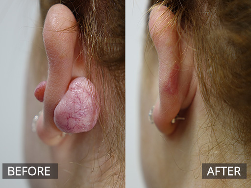 This large ear keloid required surgical debulking and then a few visits of anti-inflammatory injections. Leaving a nice outcome at 3 months. - 16