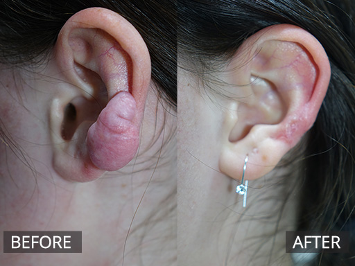 An aggressive large lower ear keloid scar developed quickly post a relatively simple ear piercing in this young lady. It was treated with scar debulking and anti-inflammatory debulking. It will require ongoing silicon gel to soften the ear to improve final appearance further. - 14