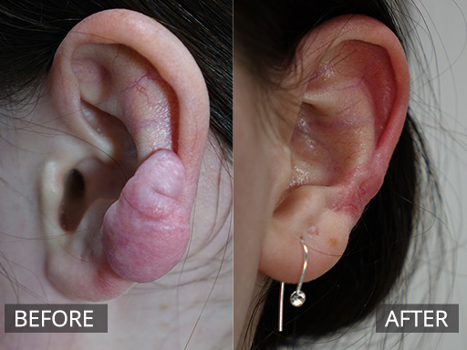 This symptomatic aggressive large lower ear keloid scar was removed with scar debulking and anti-inflammatory injections. The after image is 2 months post onset of treatment. - 13