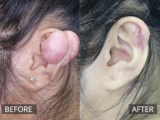 An 18 year old with extensive scar formation (Keloid scarring) of her ear post a simple ear piercing. This is 4 weeks post her scar debulking. - 7