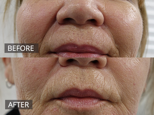 Rejuvenation of nasolabial folds with dermal fillers (2ml of a thicker dermal filler was used with a cannulae) - 5