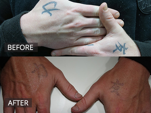 Back of hand tattoos. This is 2 months post the 3rd treatment with the Revlite Q switch laser (1064nm). - 2