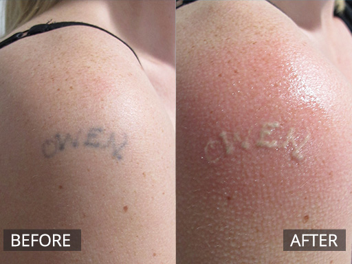 Outer arm tattoo. Immediately post the 1st treatment with the Revlite Q-switch laser (1064nm). The whitening of the tattoo is a good initial endpoint with tattoo removal. - 4