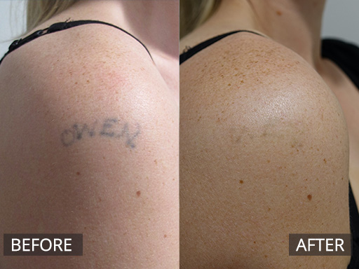 Outer arm tattoo. This is 2 months post the 3rd treatment with the Revlite Q-switch laser (1064nm). - 5