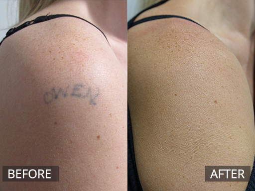 Outer arm tattoo. This is 2 months post the 4th treatment with the Revlite Q-switch laser (1064nm). - 6