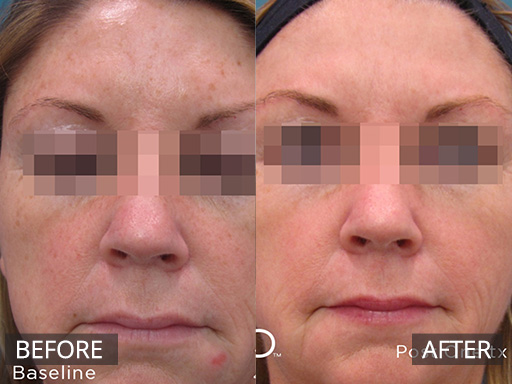 Sun damage markedly reduced with 2 treatments of the Fraxel Dual Laser (1927nm). - 6