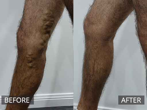 Large medial thigh and leg varicose vein (in distribution of Great Saphenous vein) treated with Ultrasound guided Sclerotherapy. - 13