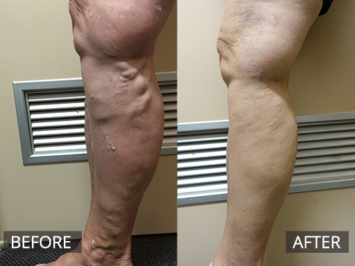 Medial leg varicose vein treated non-surgically with Ultrasound guided sclerotherapy. This is post two Ultrasound guided sclerotherapy treatments and one micro-sclerotherapy treatment. - 31