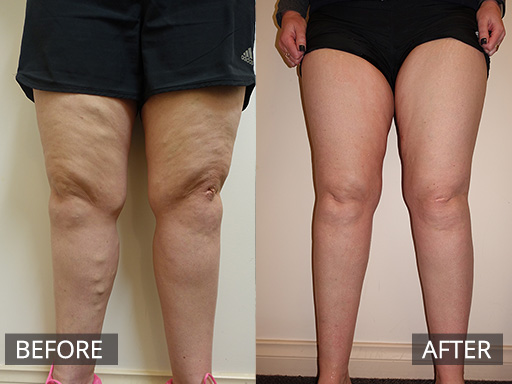 Medial thigh and leg varicose vein (distribution of the Great Saphenous vein) treated non-surgically with Ultrasound guided sclerotherapy. This result is post one treatment and the after image is 1-month post treatment. - 32