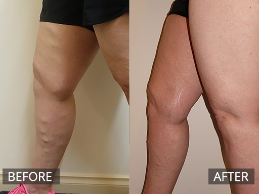 Medial thigh and leg varicose vein (distribution of the Great Saphenous vein) treated non-surgically with Ultrasound guided sclerotherapy. This result is post one treatment and the after image is 1-month post treatment. - 21