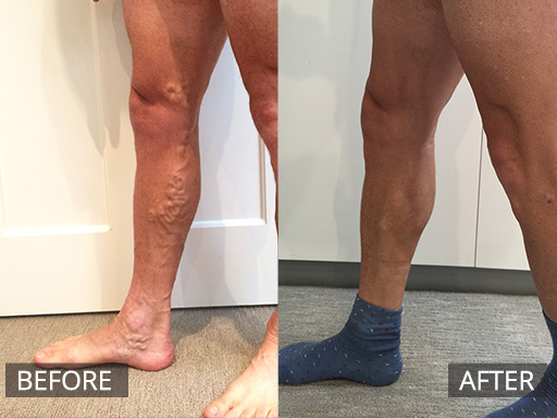 Extensive non-painful medial leg and thigh varicose veins treated successfully non-surgically with a combination of Ultrasound guided sclerotherapy and micro-sclerotherapy. The after image is 4 months post last treatment. - 34