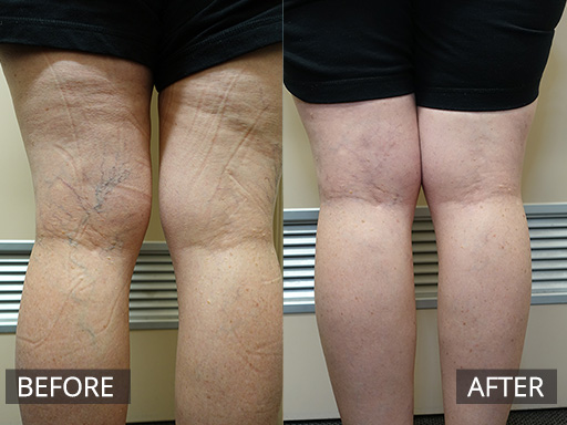Bilateral posterior thighs and leg spider veins treated with micro-sclerotherapy over 3 months (4 visits). - 8