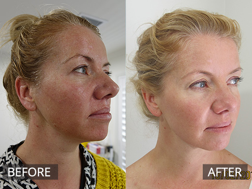 Factor 4 treatments involve injections and drizzling of your own growth factors (autologous) into your skin to improve the skin appearance. This is post 4 treatments of Factor 4 combined with Medical Skin Needling. - 3