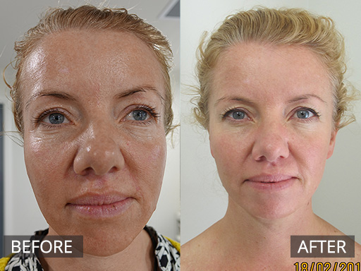 Factor 4 treatment combined with Medical skin needling. This patient had 4 treatments of Factor 4 spaced at 3 weeks apart. - 4