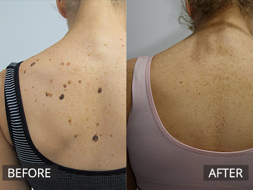 Multiple benign lesions on back removed with radiofrequency (Before and 12 months later) - 34
