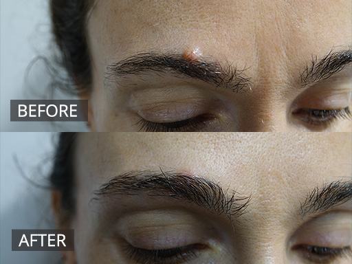 Eyebrow Mole Removed with no hair loss (Before and 2 months post) via Radiofrequency. The Residual redness fades over few months. - 20