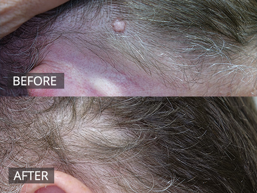 Scalp mole removed via Radiofrequency (Before and 2 months post) - 19