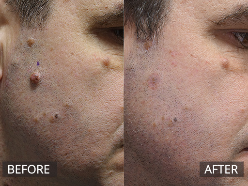 Lateral Right face (*3) moles removed via Radiofrequency (Before and 2 months post). The visible post redness fades usually by 3-4 months. - 14
