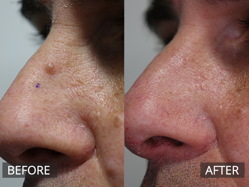 Lateral nose mole removed via Radiofrequency (Before and 4 months post) - 13