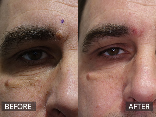 Medial Eyebrow Mole removed via Radiofrequency (Before and 2 months post). The visible post redness fades usually by 3-4 months - 12
